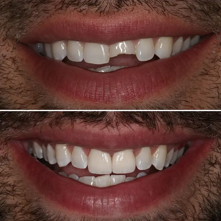 Same-Day Dental Crowns