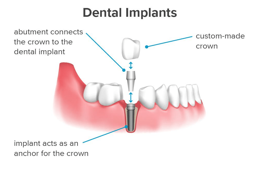 Dental implant