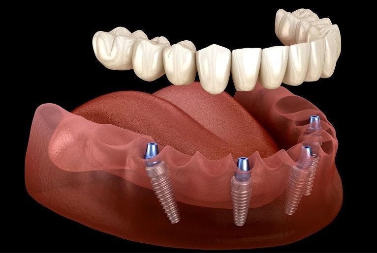 All-On-X Implant