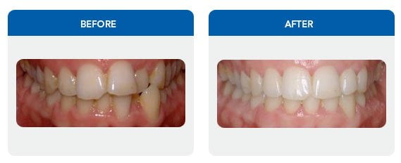 cross-bite-after-sydney