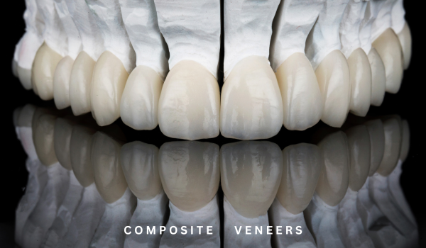 Composite Veneers