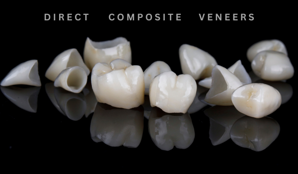 Direct Composite Veneers