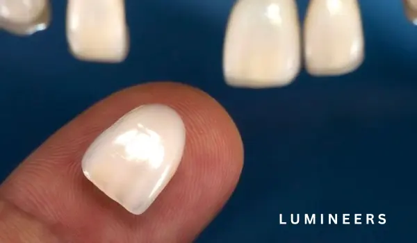 Lumineers Veneers