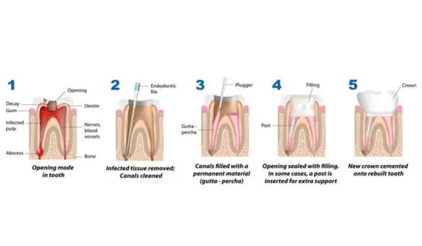 root canal treatment