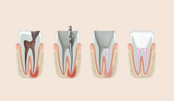 root canal service in sydney