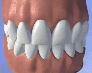 About Dental bridges