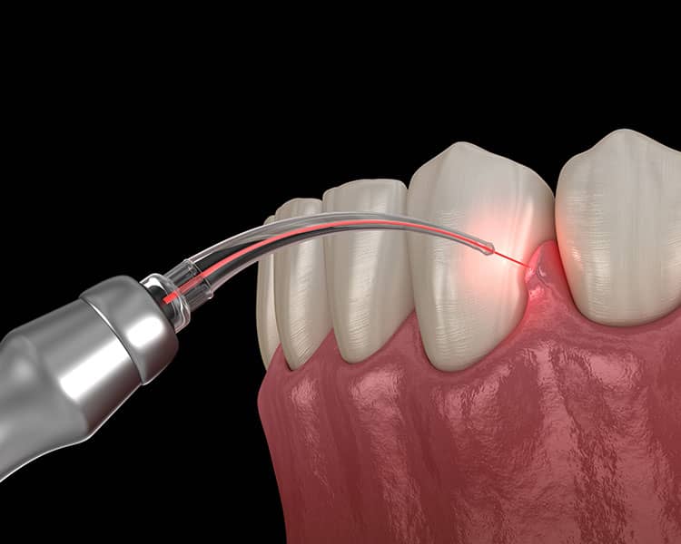 laser-dentistry