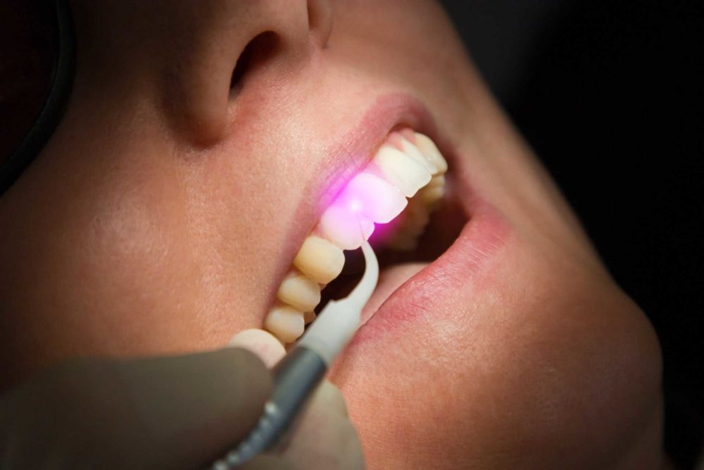 laser-dentistry