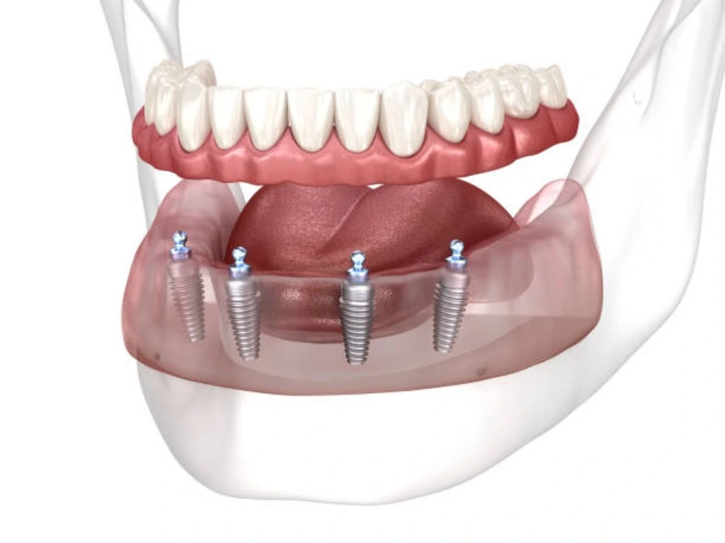 Dental implant-supported dentures procedure with benefits and cost overview