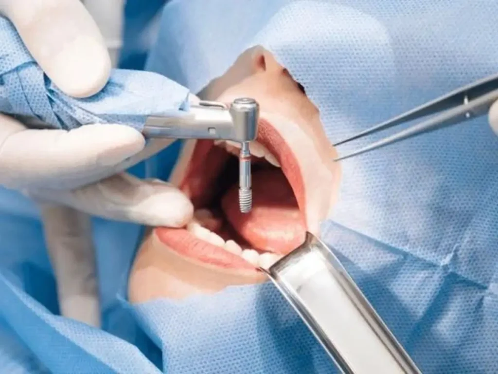 Step by step guide on the how dental implant work and procedure and what to expect from treatment