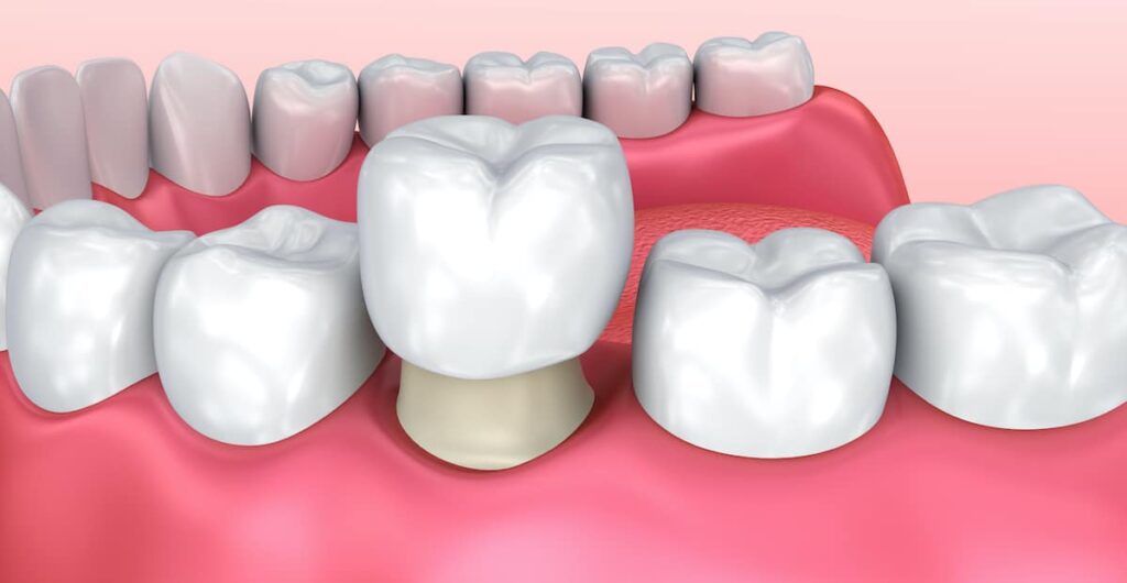 Porcelain dental crown restoring function and appearance of a tooth after root canal treatment