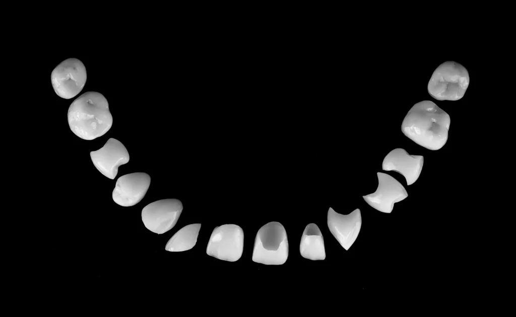 types of veneers