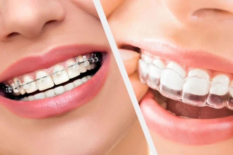 Invisalign or Traditional braces Choosing the right solution for teeth straightening.