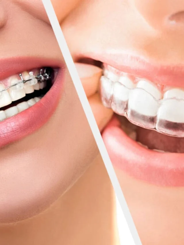 Invisalign vs Traditional Braces Which Solution is the Best Fit for You