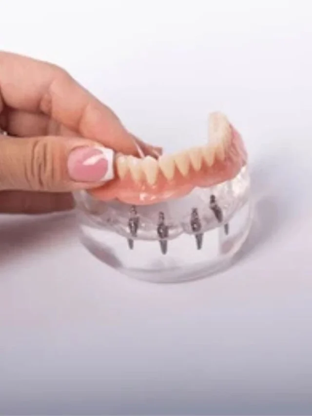 Transform Your Smile with Implant Supported Dentures