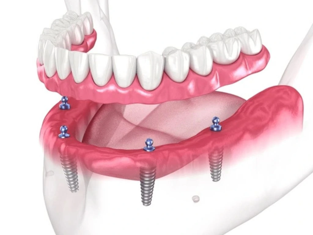 implant supported dentures being placed in a patient's mouth, showcasing the dental implants and prosthetics for improved smile and functionality