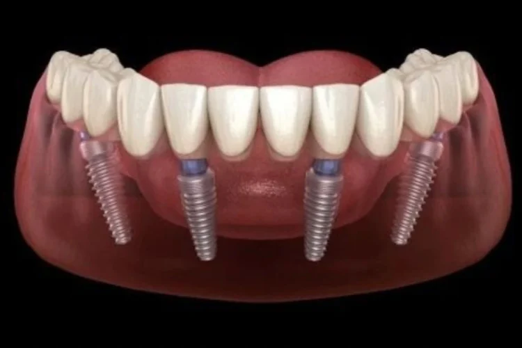 All on 4 Dental Implants: The Best Alternative to Dentures 11 Consider our clinic for Best All on Four dental implants in Liverpool NSW