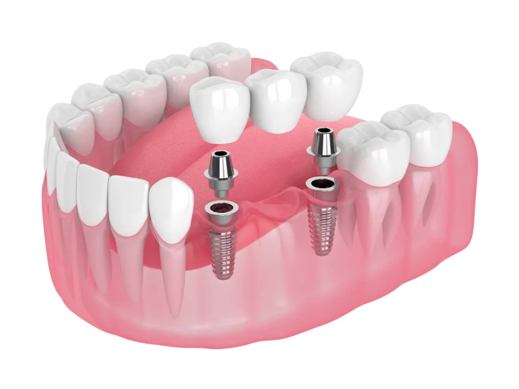 Dental Implant Dental Implants Liverpool & Blacktown — Restore Missing Teeth with Confidence Dental Implant 46 What are implant supported bridges