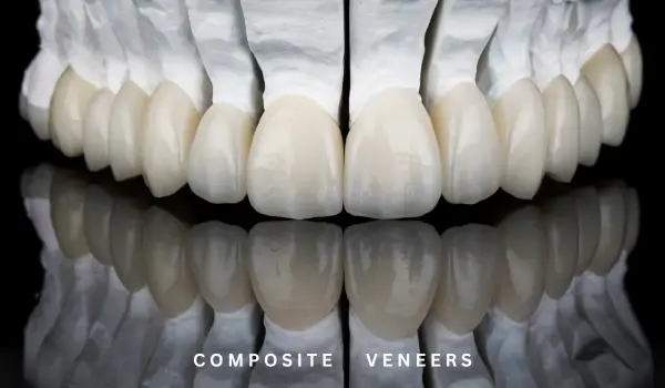 Dental Veneers 7 Composite veneers for perfect smile