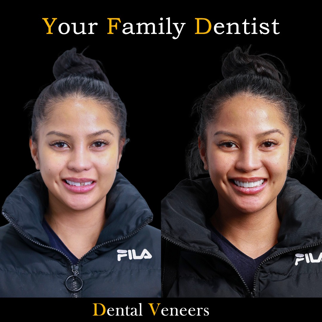 Dental Veneers 20 Dental Veneers