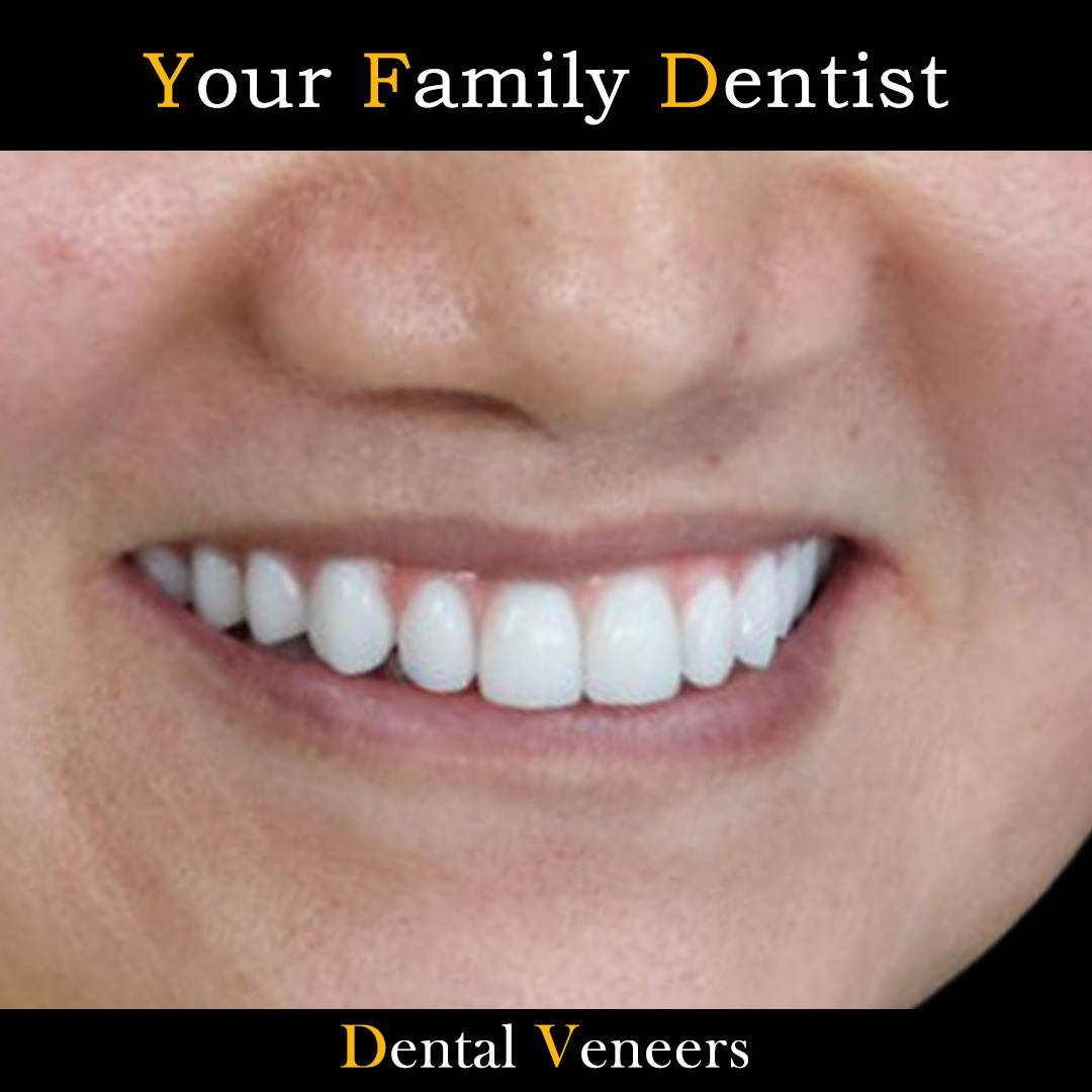 Dental Veneers 14 Dental Veneers _11zon
