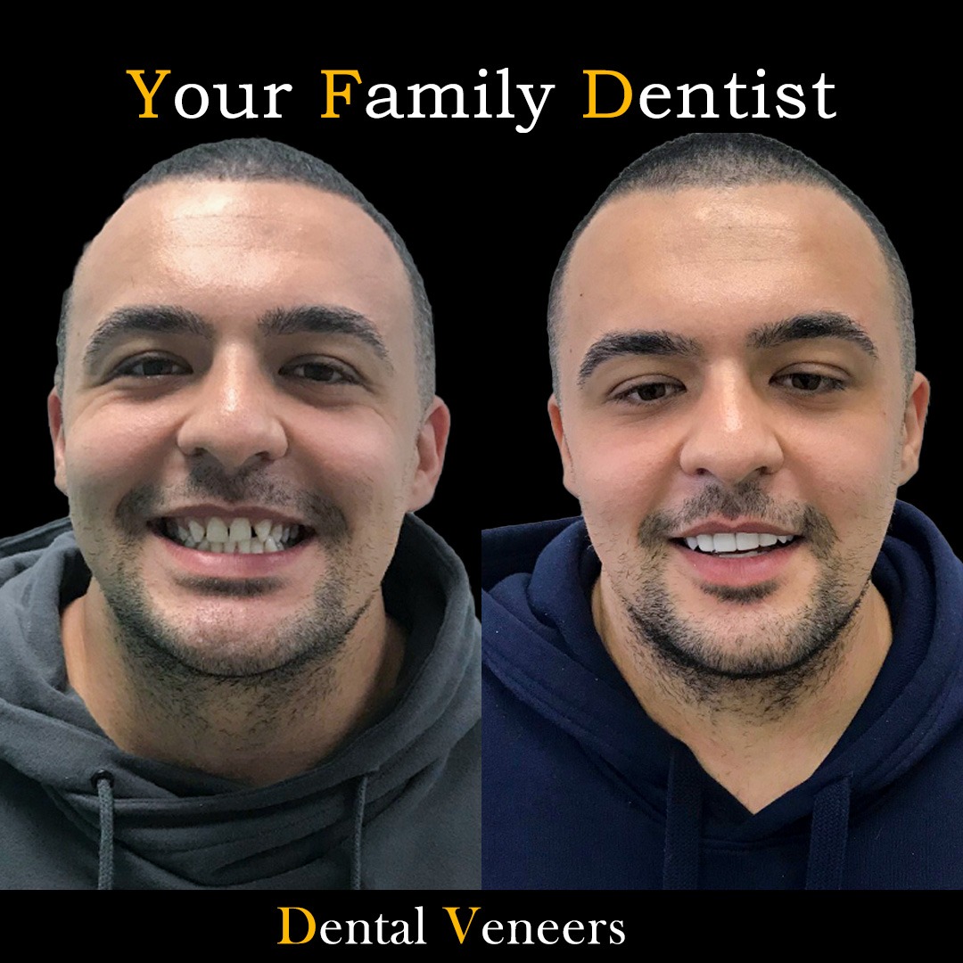 Dental Veneers 23 Dental Venners