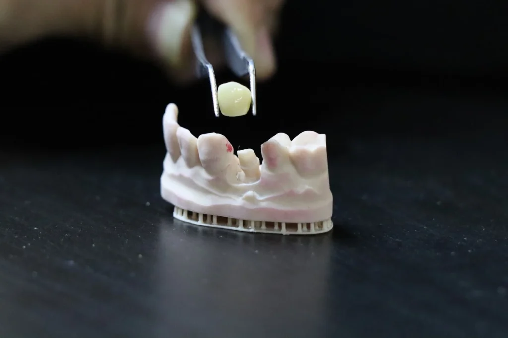 Same Day Crown 5 what are dental crowns