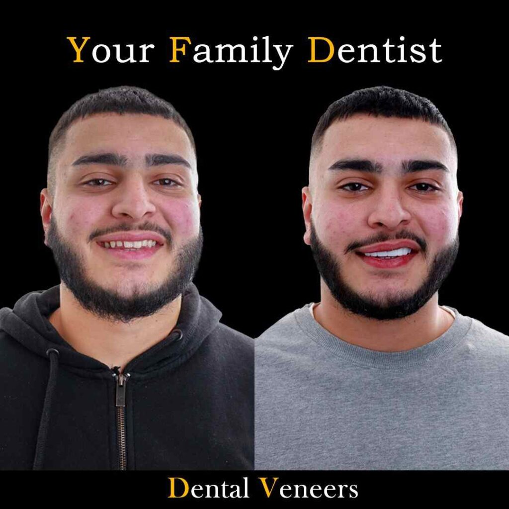 veneers