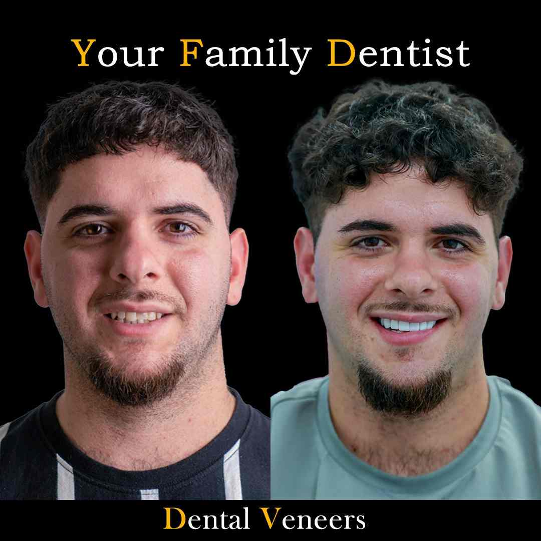 Dental Veneers 19 veneers
