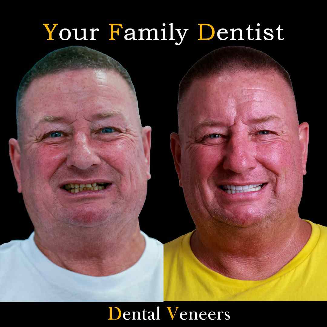 Dental Veneers 17 IMG-20250123-WA0015_11zon