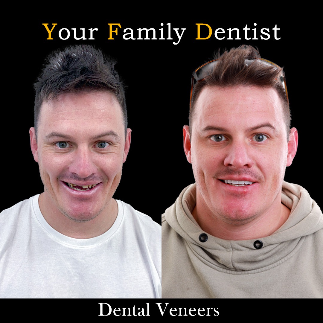 Dental Veneers 24 Dental Veneers