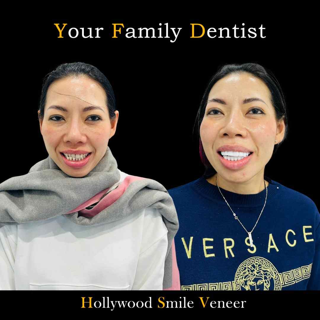 Dental Veneers 25 Holywood Smile Veneers