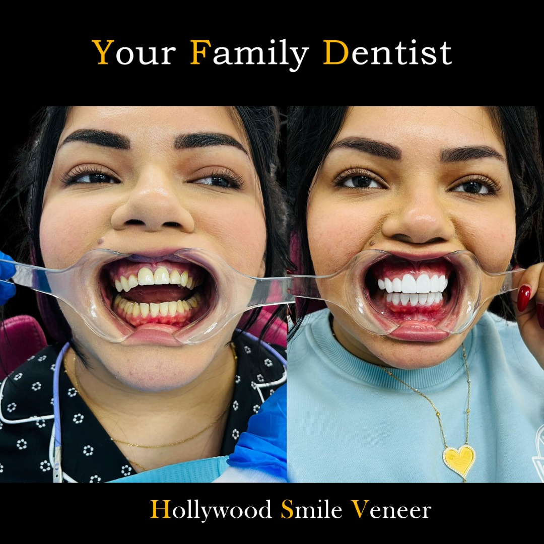 Dental Veneers 21 veneers