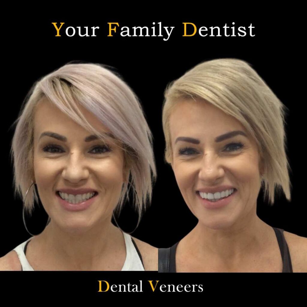 Veneers