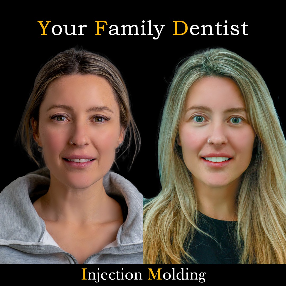 Dental Veneers 16 Injection moldeing