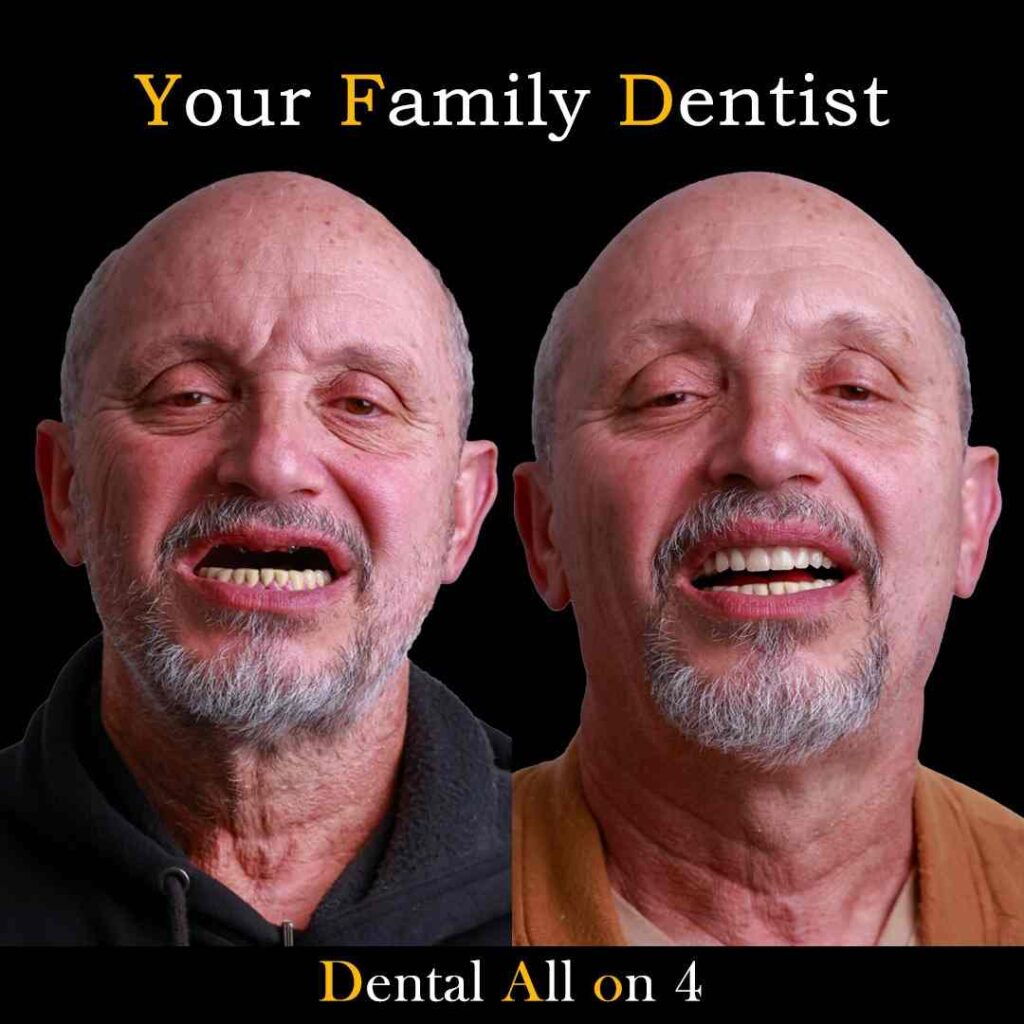 Dental Implant Dental Implants Liverpool & Blacktown — Restore Missing Teeth with Confidence Dental Implant 43 All on 4