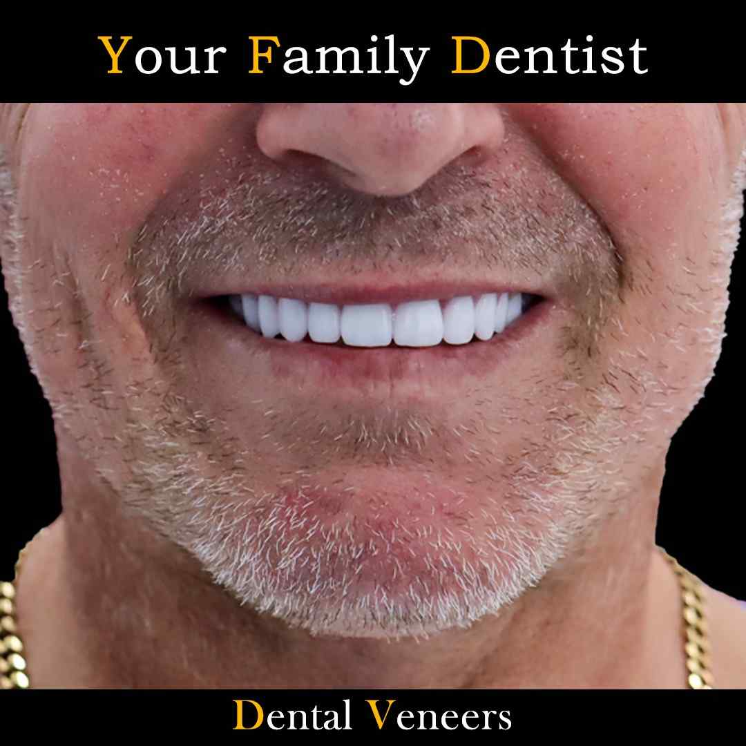 Dental Veneers 15 WhatsApp Image 2025-01-23 at 15.32.49_6077cbf9_11zon