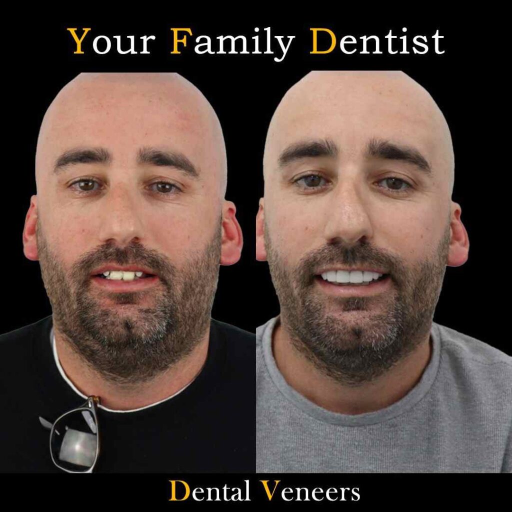 Veneers