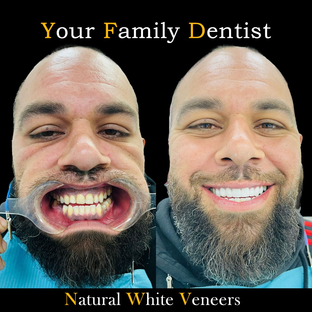 Dental Veneers 22 Natural White Veneers