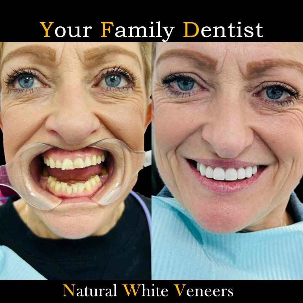 Dental veneers