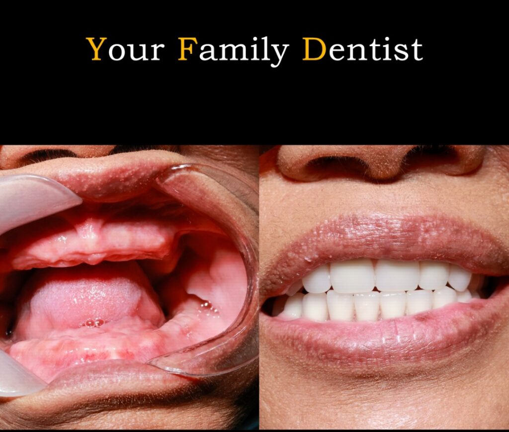 Dental Implant Dental Implants Liverpool & Blacktown — Restore Missing Teeth with Confidence Dental Implant 44 What are full-mouth dental implants?