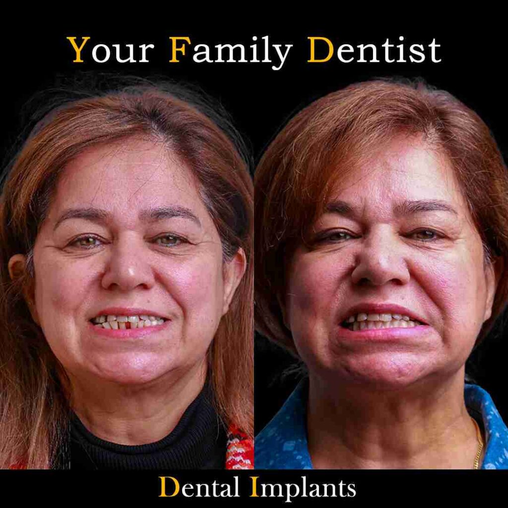 Dental Implants
