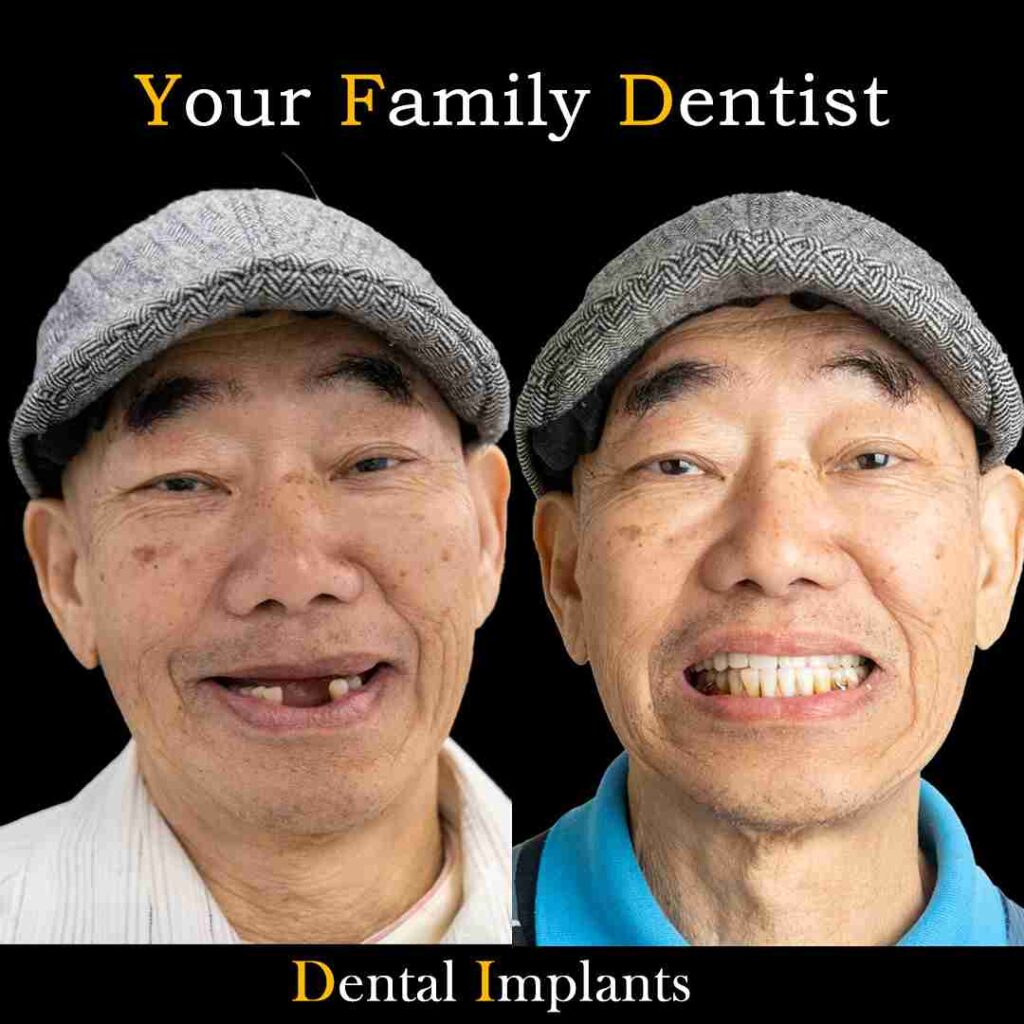 Dental implants