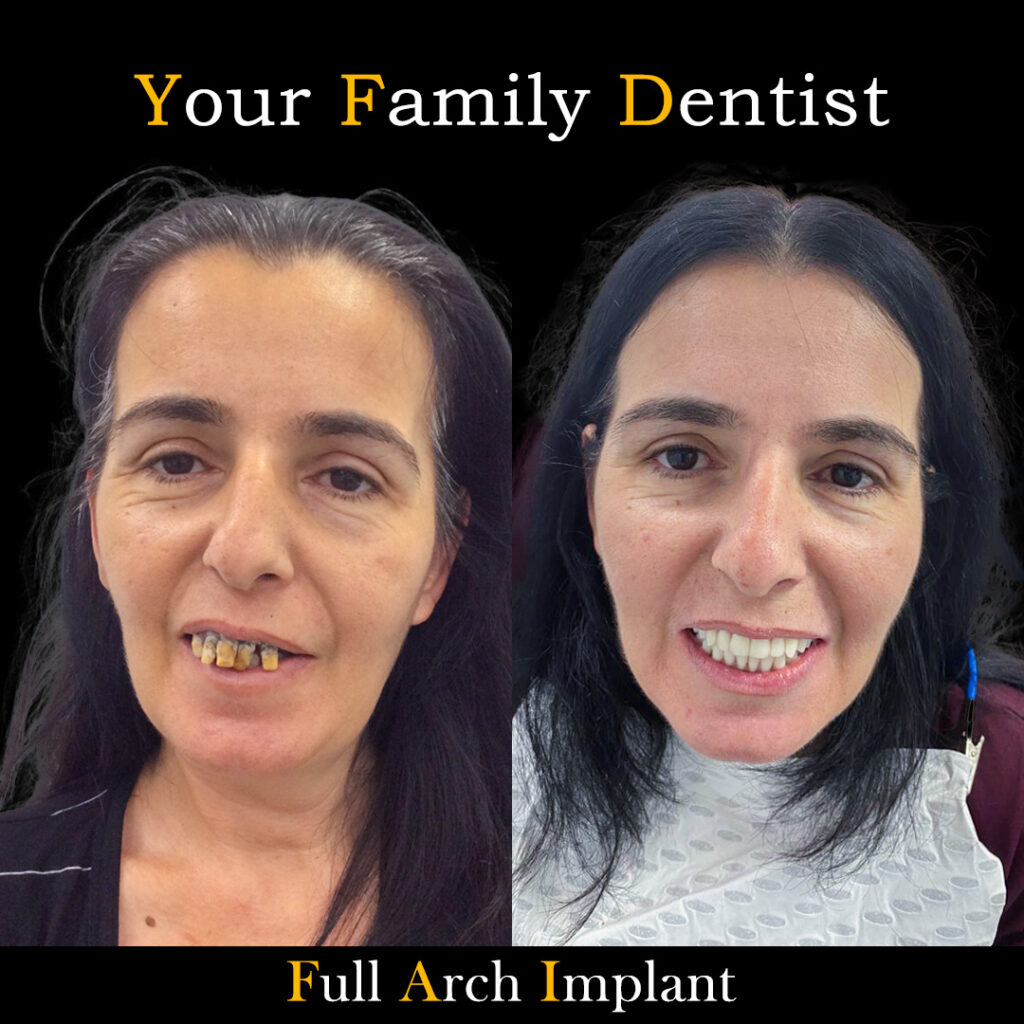 Before and After Full Arch implant 2