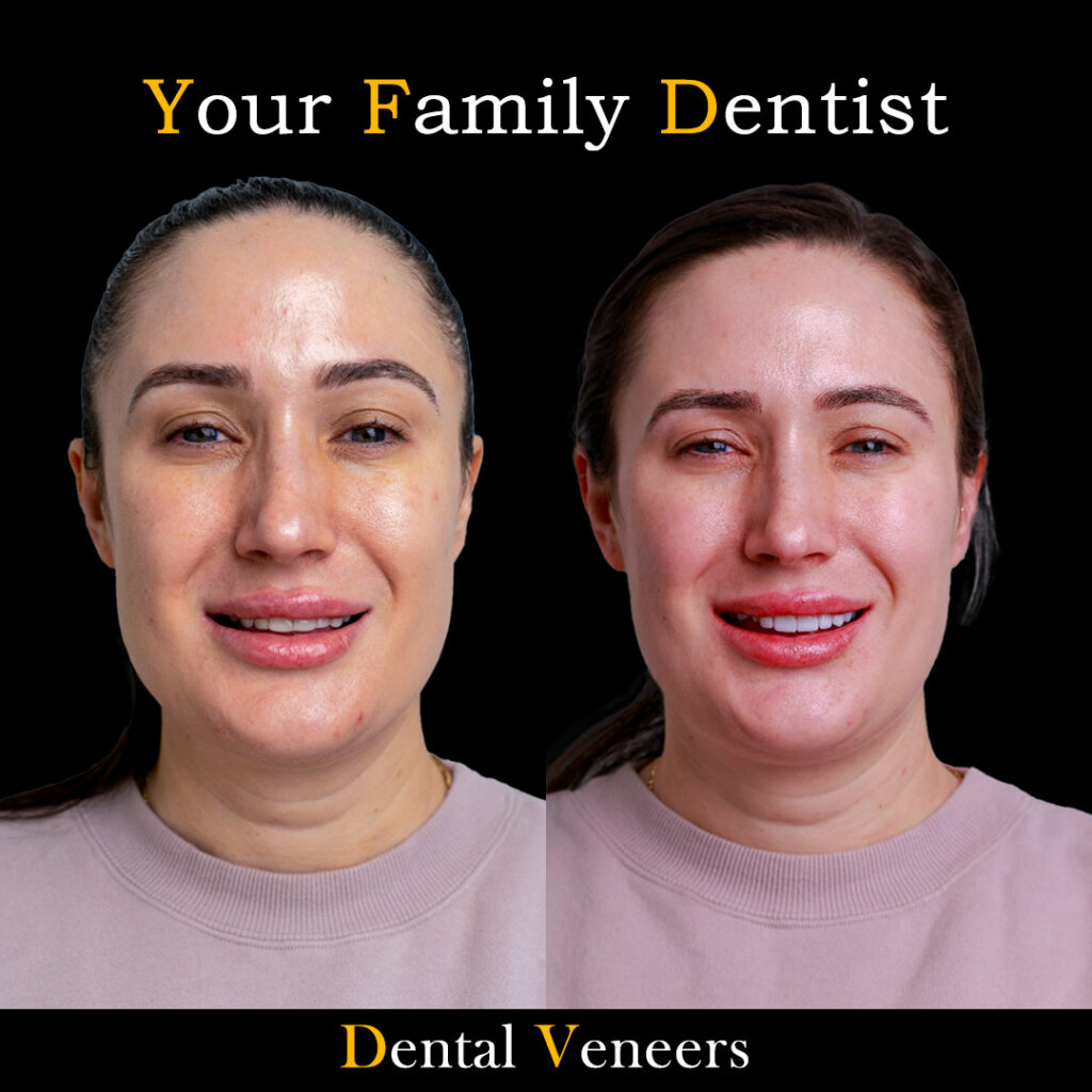 veneers
