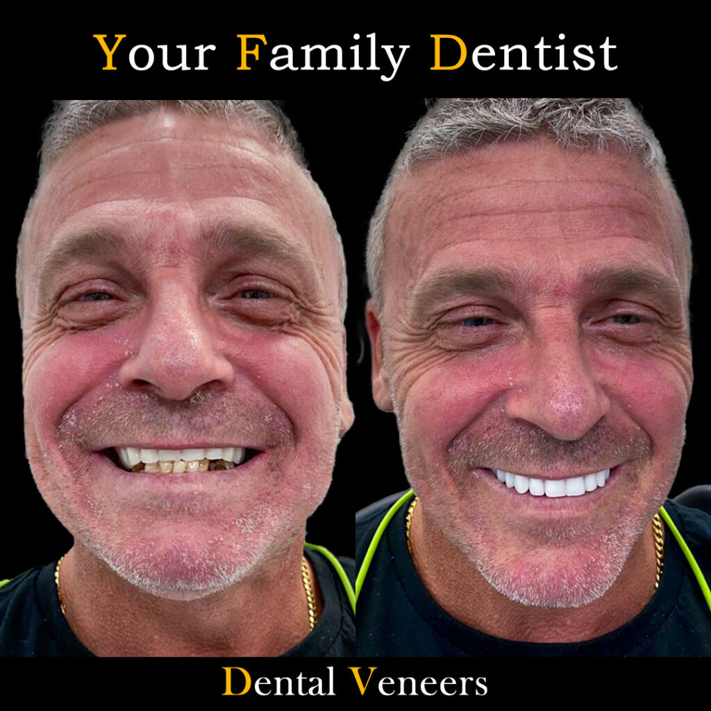 veneers