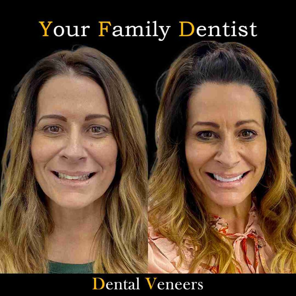 Veneers