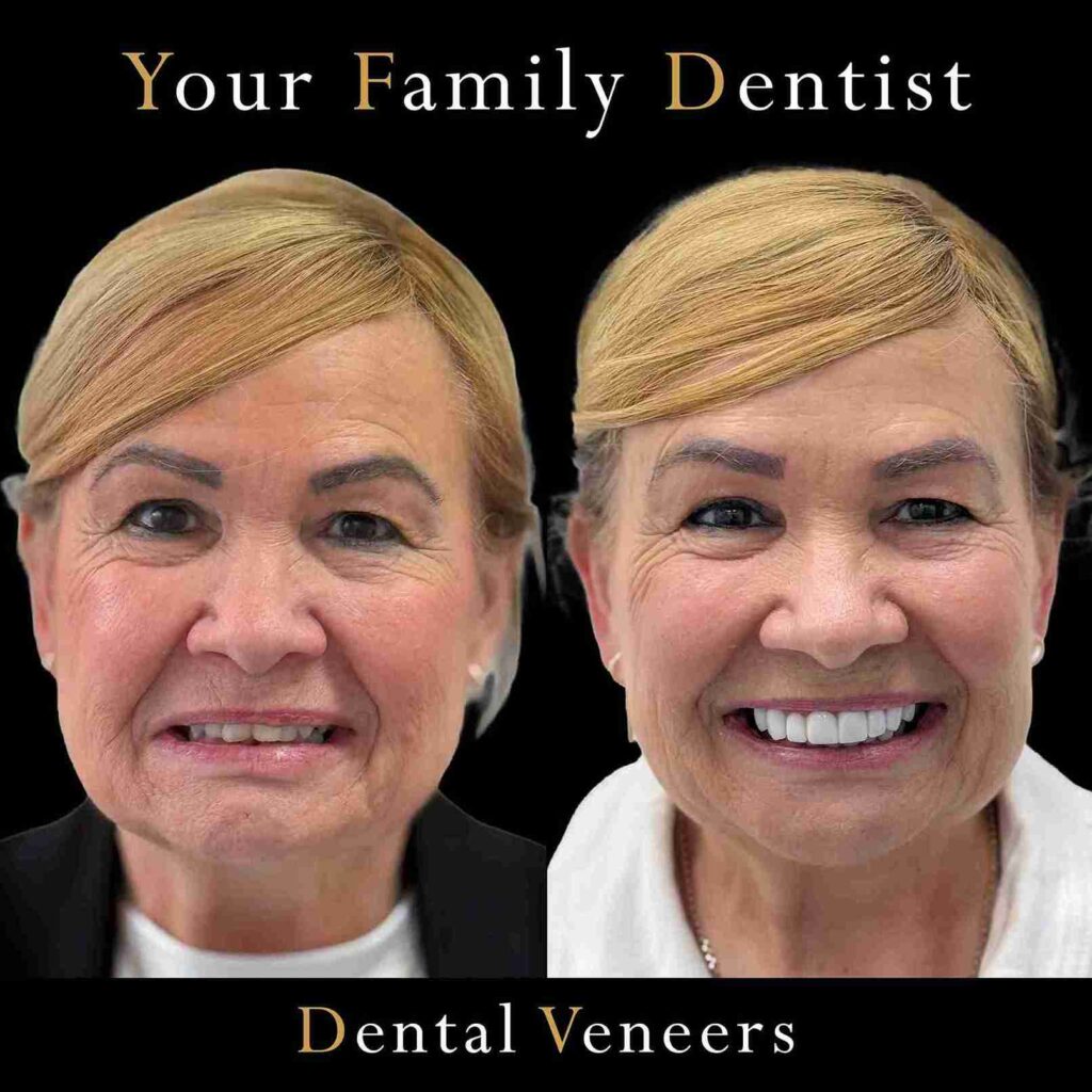 Dental Implant All On X