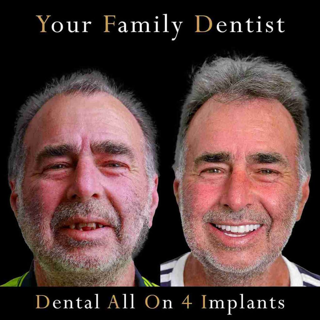 Dental Implant