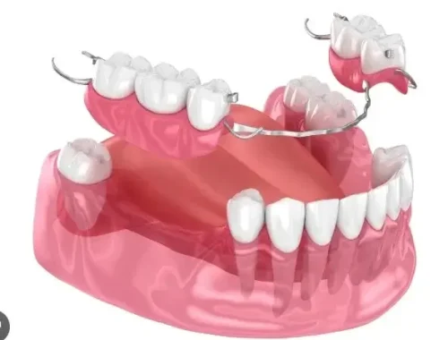 Partial dentures to fill gaps and restore a healthy smile